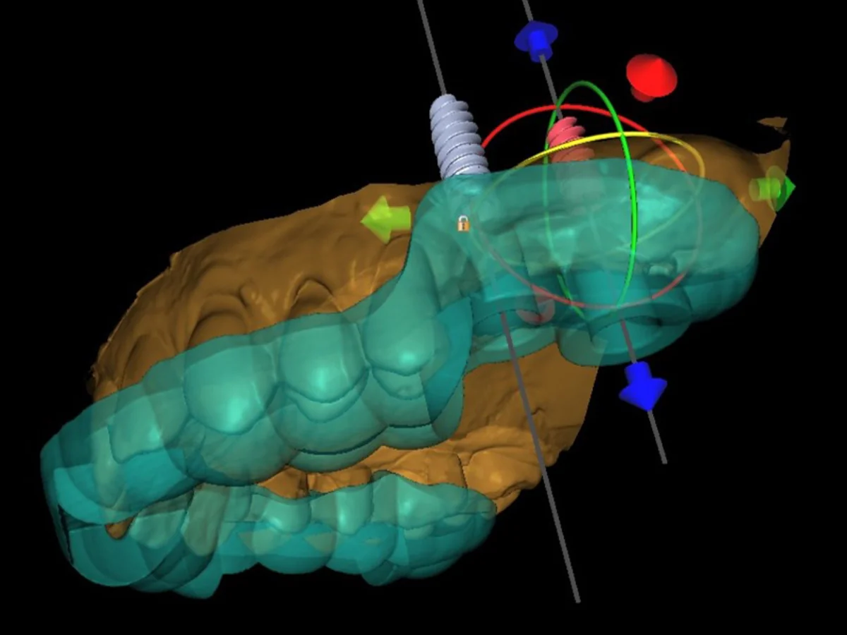 Computergest&uuml;tzte Implantatplanung